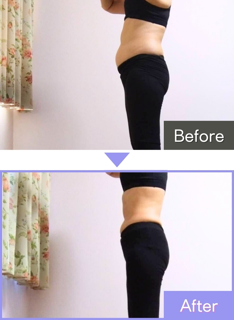 IEDEMOダイエット実施後の写真